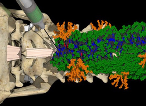 Spinal Cord Breakthrough