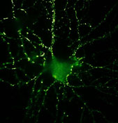 The memory-building synapses of a brain cell are under attack by ADDLs (yellow), toxic proteins discovered by researchers at Northwestern, which could explain Alzheimer